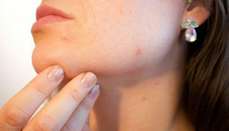 Acne Treatment