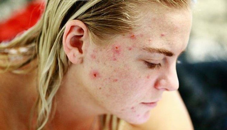 Treating Teen Acne
