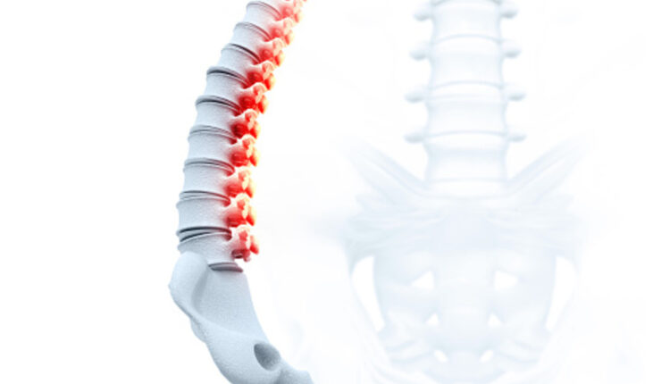 spondylosis
