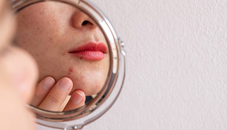 How to Find the Root Cause of Your Acne