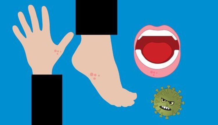 hand foot mouth disease