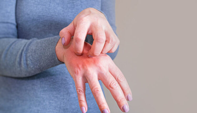 scabies rash