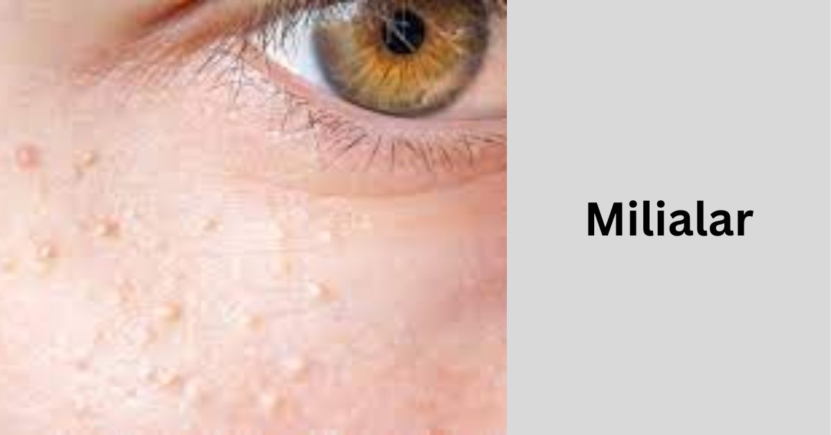 milialar