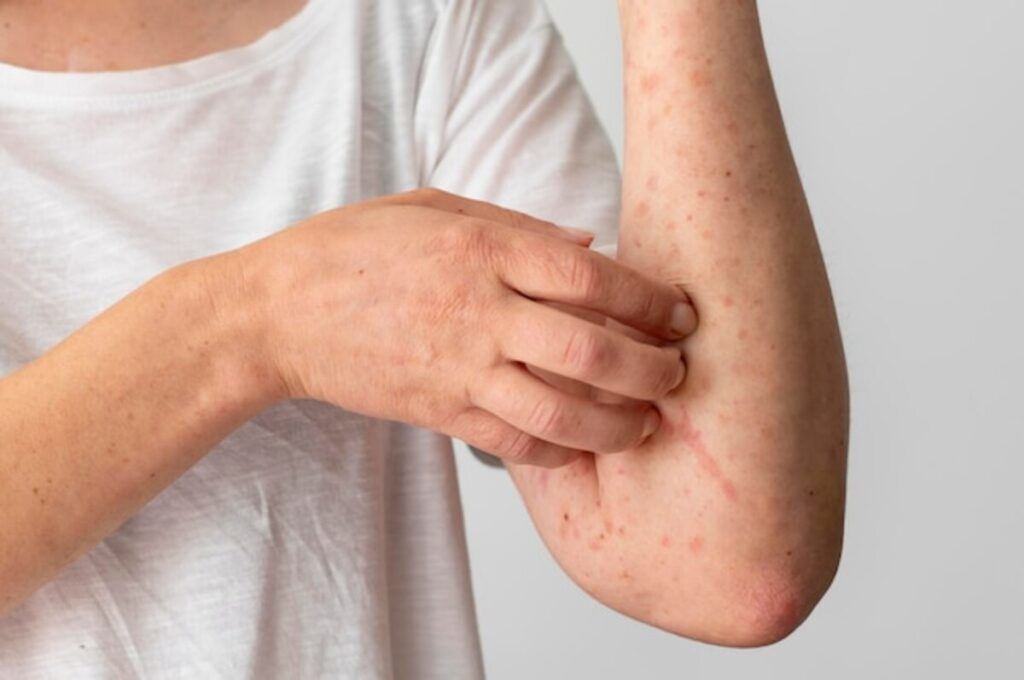 chafing treatment
