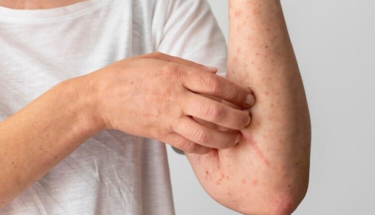 chafing treatment