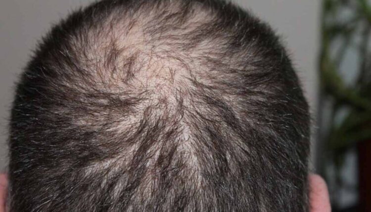 PRP for hair loss