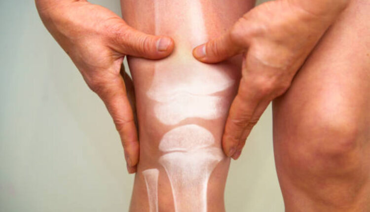 physio for knee pain