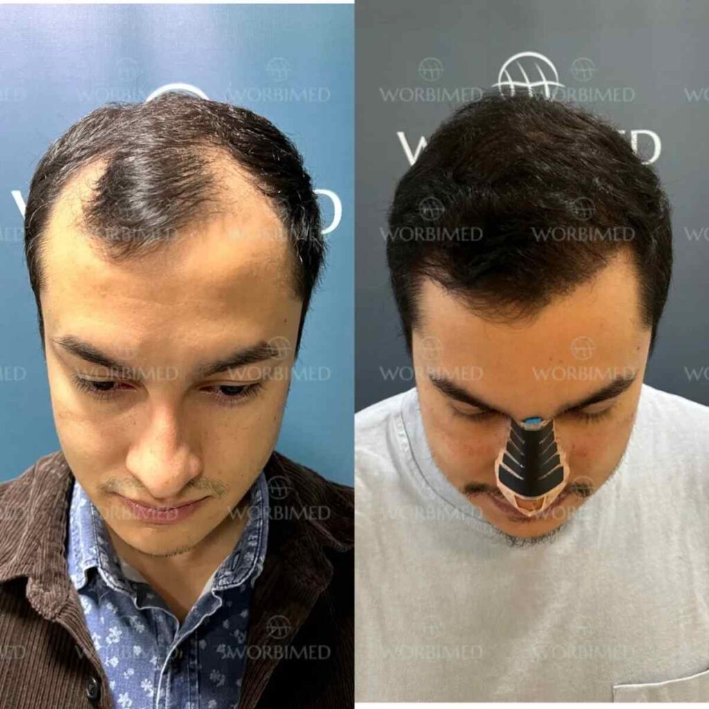 Hair transplant in Turkey