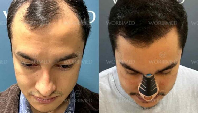 Hair transplant in Turkey