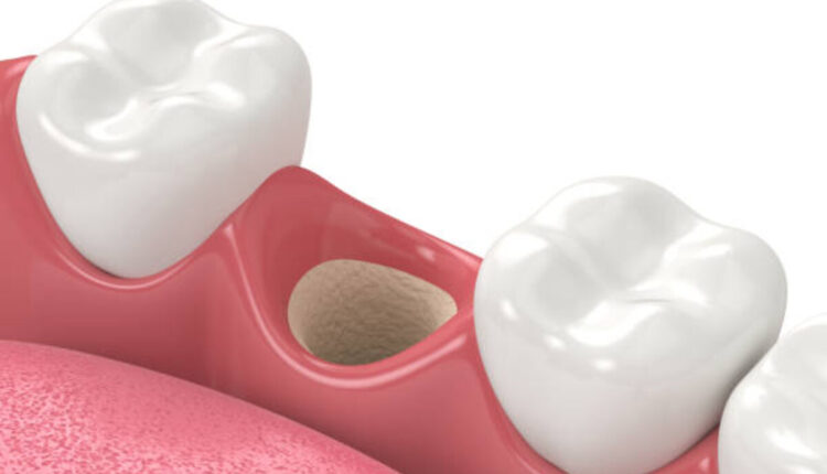 Invisalign Maple Ridge