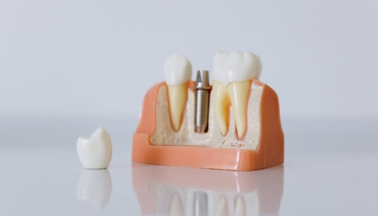 Implant Dentist Brisbane