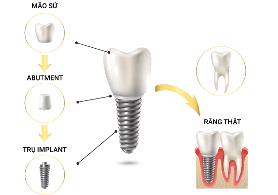Implant
