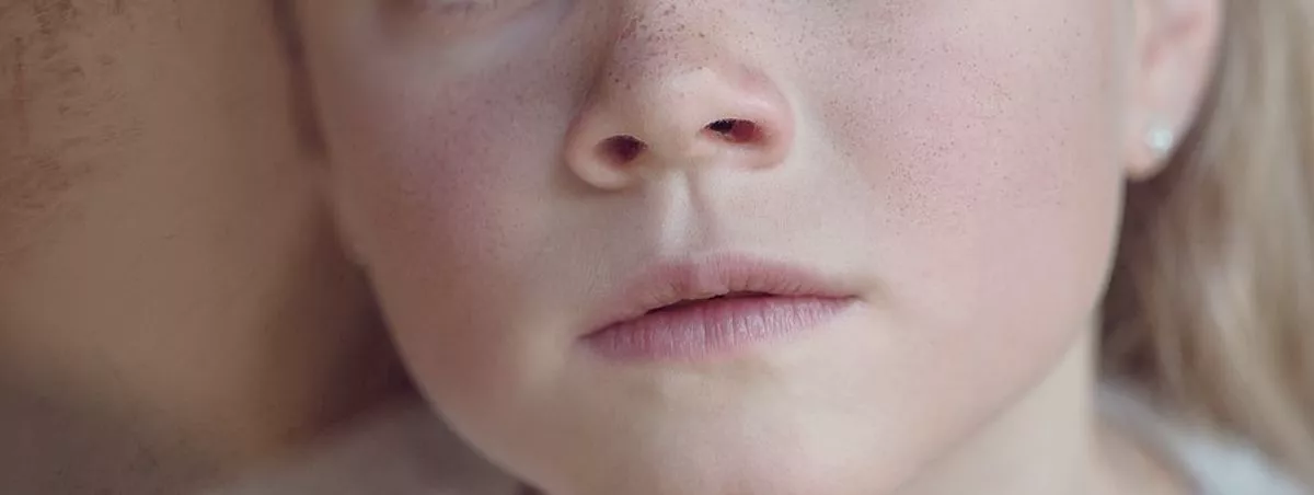 How to Get Rid of Blackheads