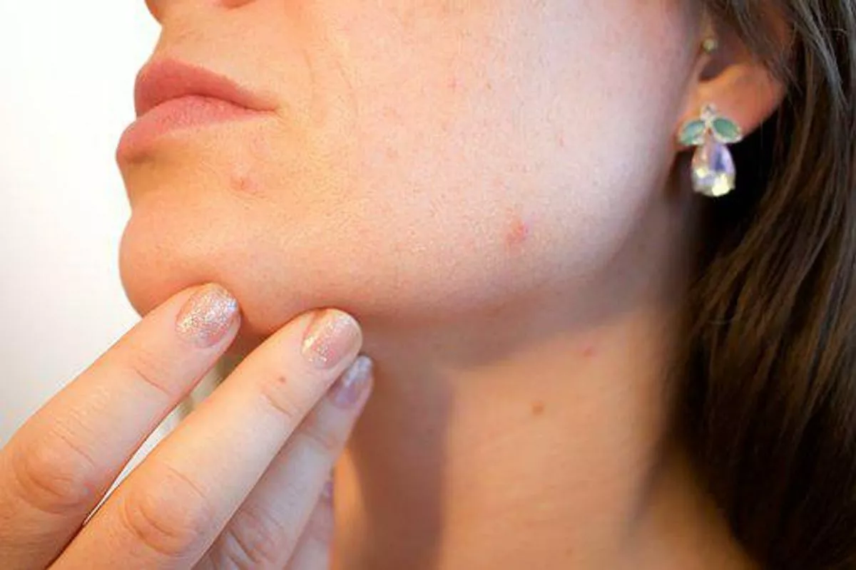 Acne Treatment