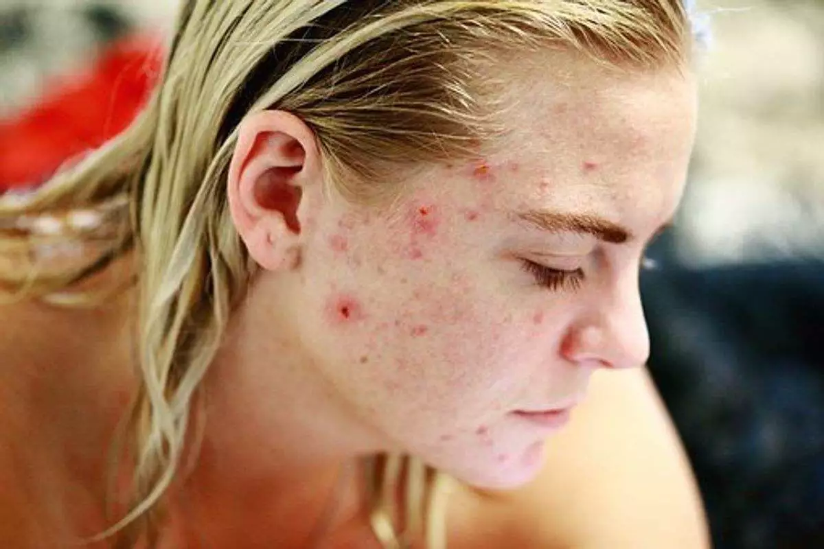 Treating Teen Acne