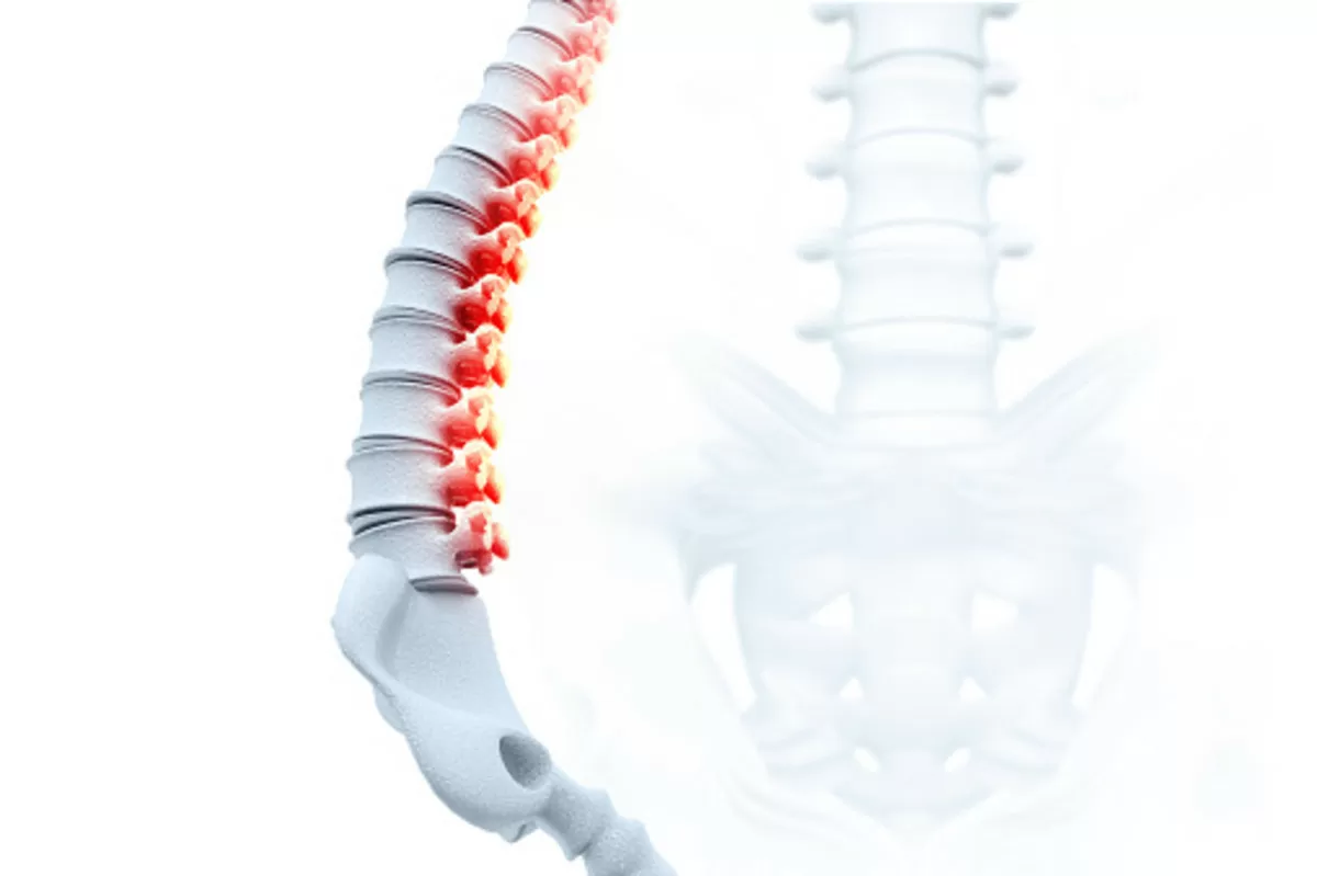 spondylosis