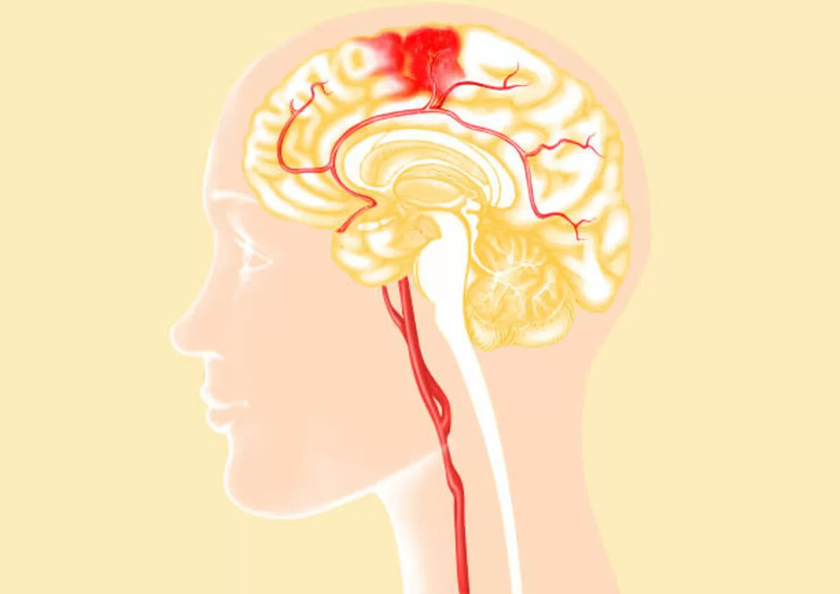 stroke symptoms