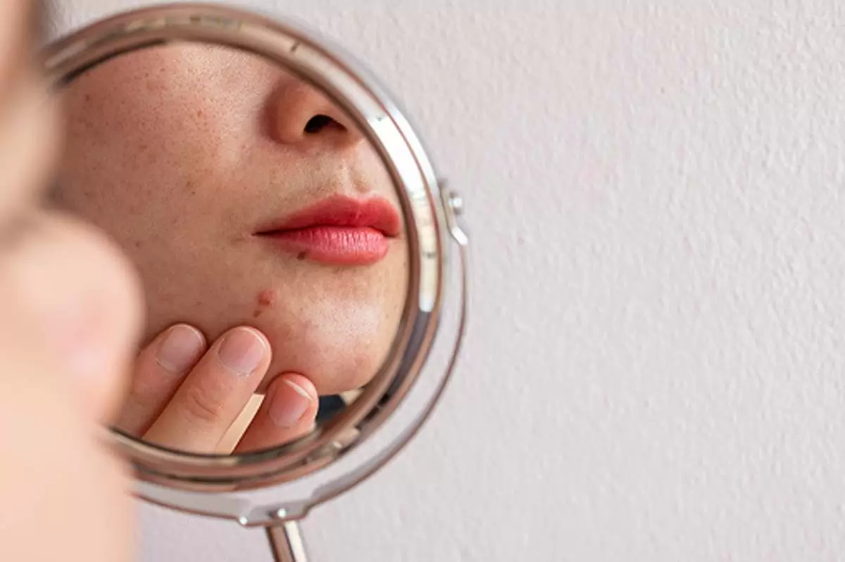 How to Find the Root Cause of Your Acne