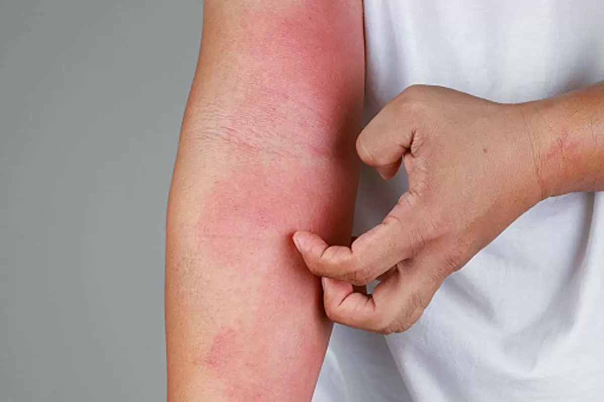 Natural Cures For Skin Allergies