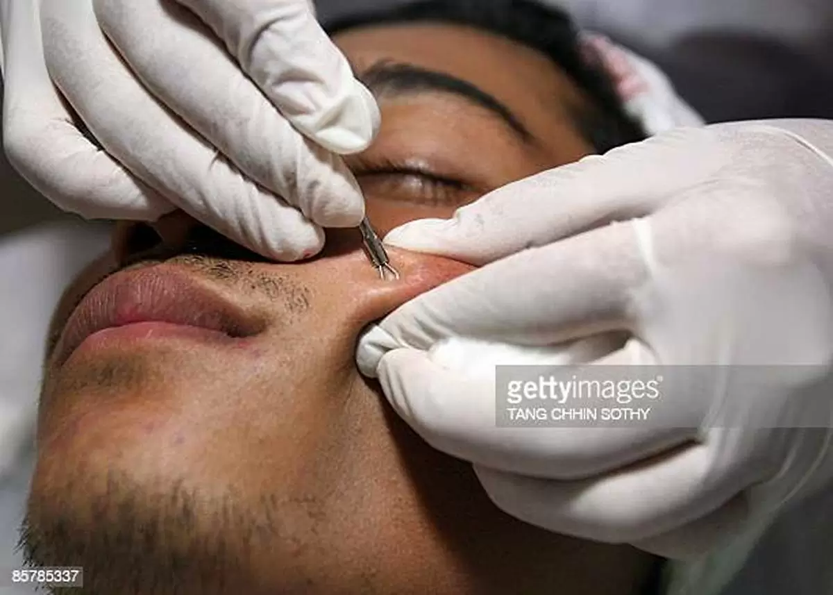 The Causes Of Pimples