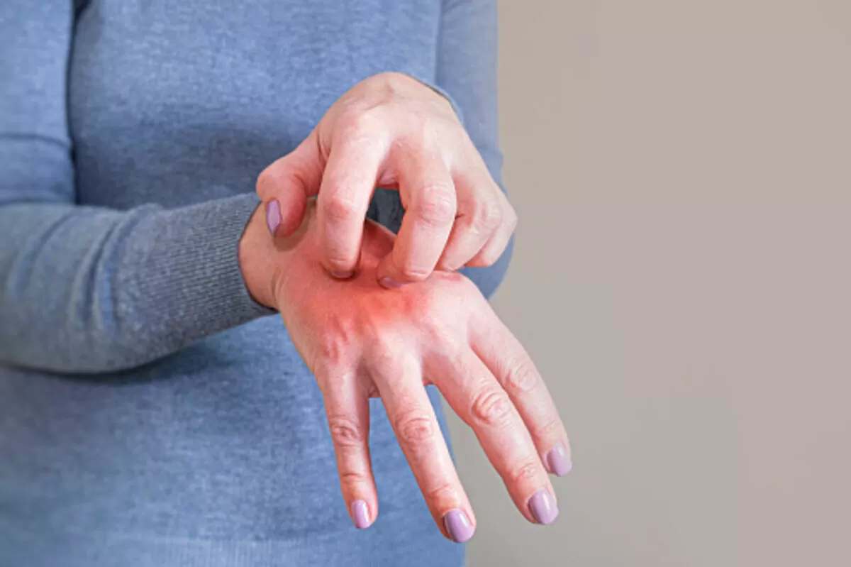 scabies rash