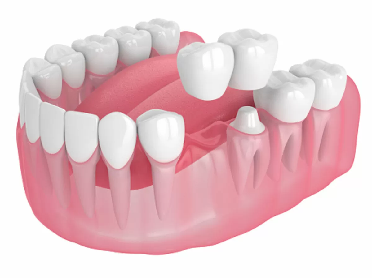ceramic implant center! 