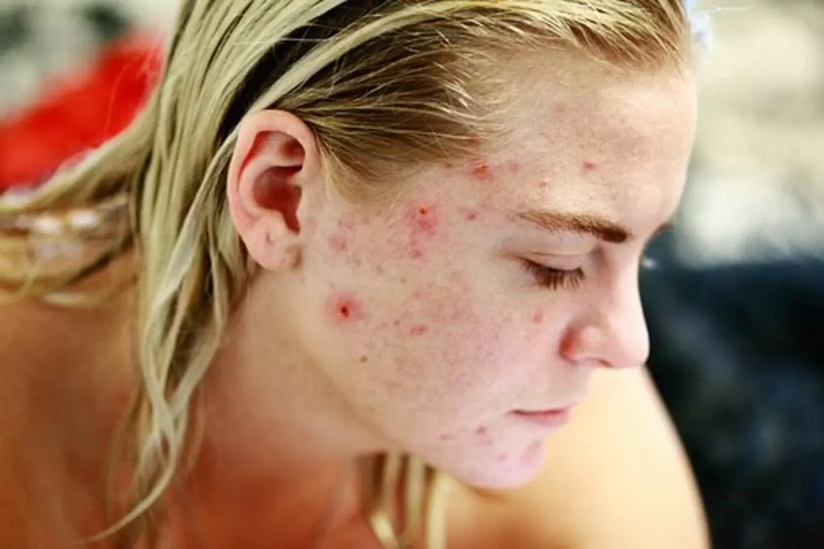 how to care for blemished skin
