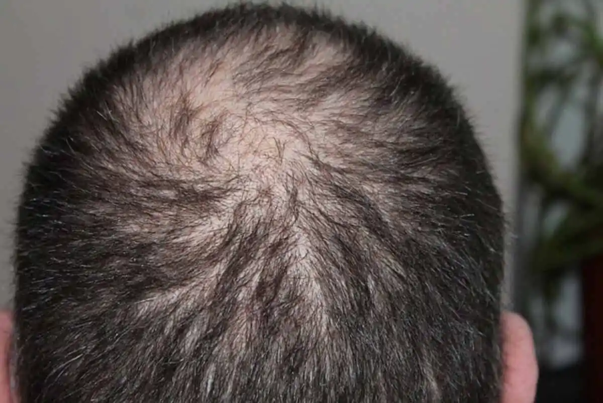 PRP for hair loss