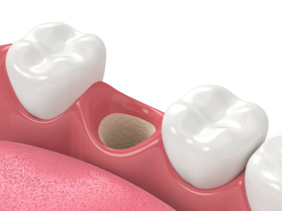 Invisalign Maple Ridge