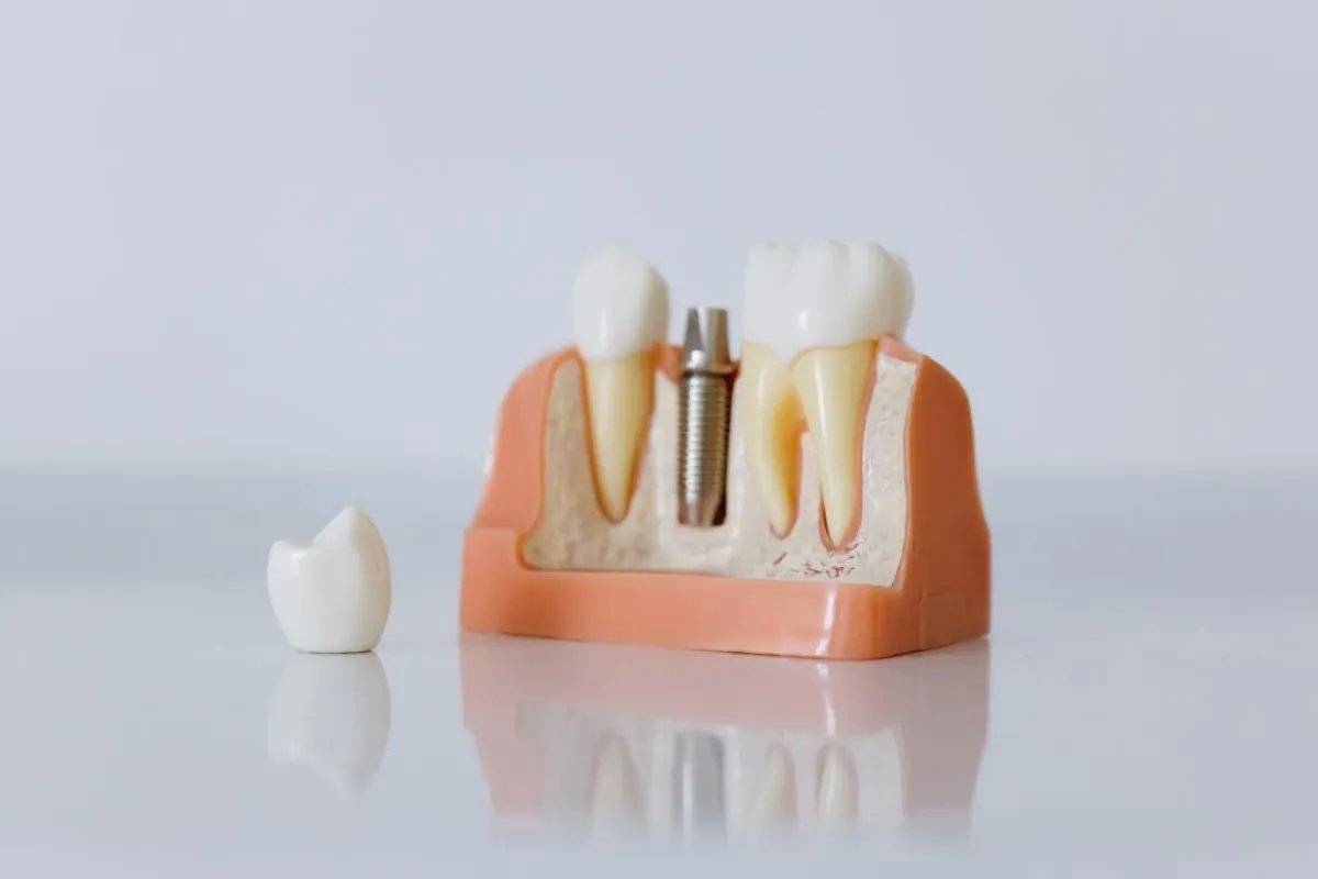 Implant Dentist Brisbane